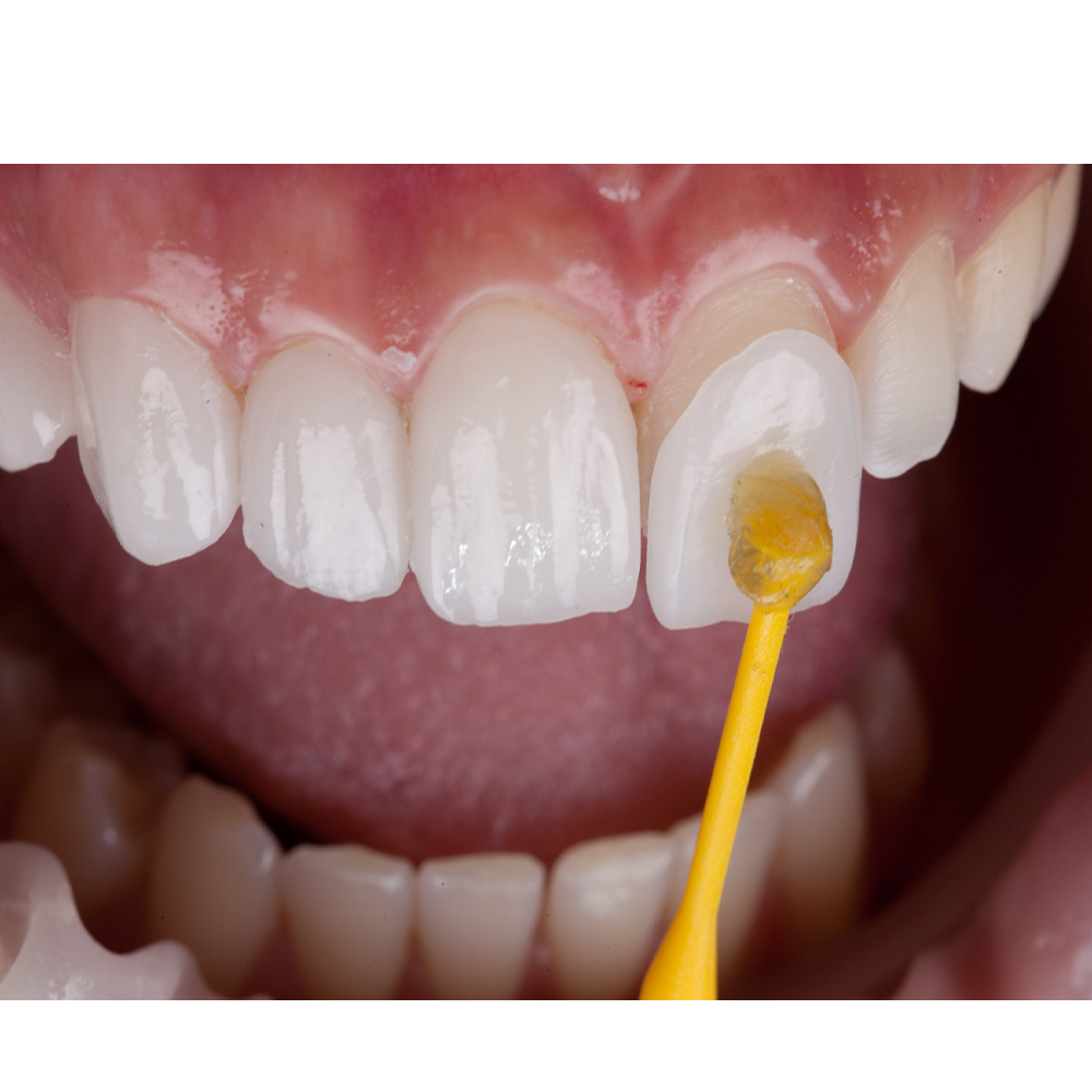 Teeth Whitening