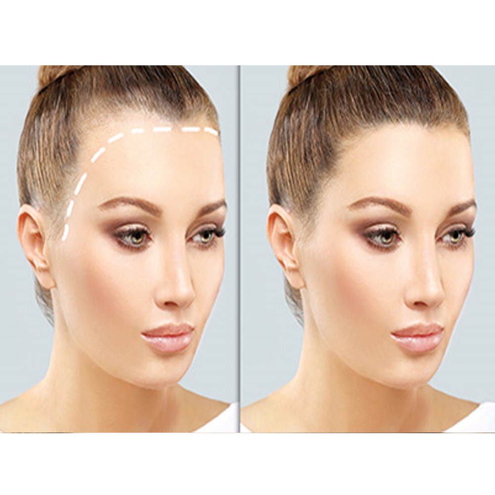 Hair transplant